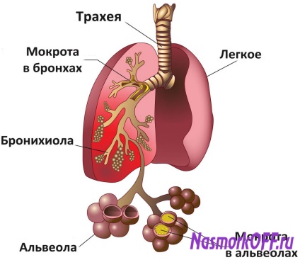 Care sunt simptomele tusei convulsive la copii și semnele adulte, tratament, recomandări