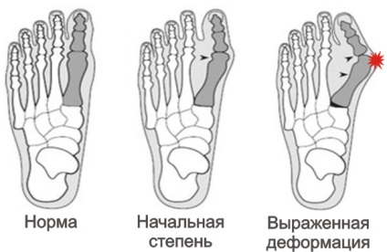 Medicul care vindecă un os pe picior, ce fel de doctor ar trebui să se consulte cu un bum pe picior lângă degetul mare