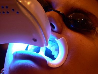 Hogyan működik a fogfehérítés otthon fogak és fogászati