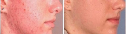 Hogyan lehet eltávolítani a nyomokban (post-acne), acne arcán otthon