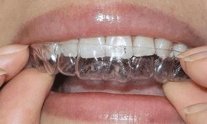 Cum să aliniați dinții strâmbi fără acoperișuri