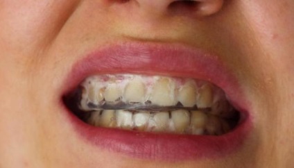 Dinți albirea dinților, cunoștințe utile pentru toți