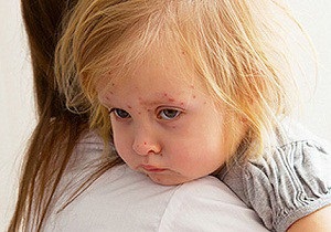 Kanyaró gyermekek tünetei és kezelése, megelőzése, fotók a kiütés