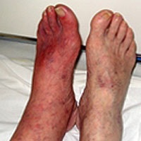 Diabéteszes láb tünetei és kezelése