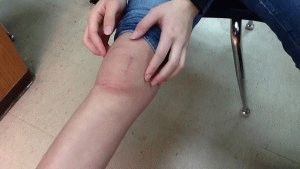 Tratamentul genunchiului genunchiului pentru primul ajutor și terapia modernă