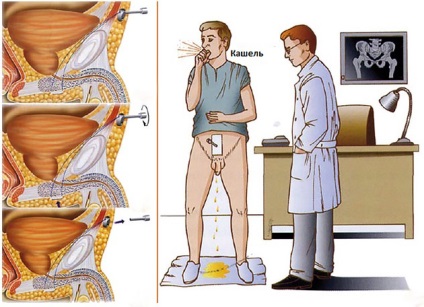 Vizelet inkontinencia kezelésére férfiaknál, Urology Clinic Első MGMU őket