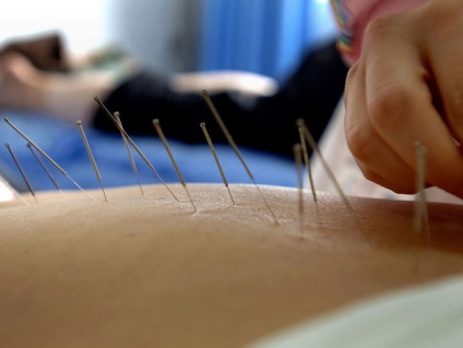 Tratamentul bolilor tractului gastro-intestinal prin acupunctură