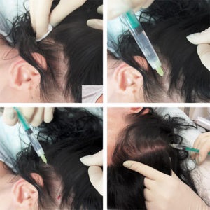 Mezoterapia cu căderea părului