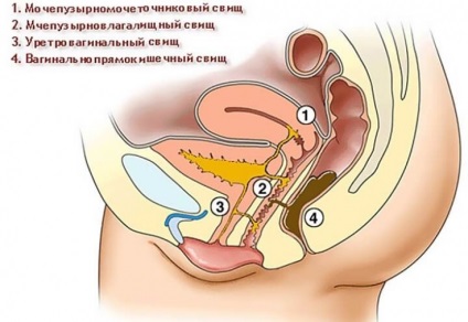 Genitourinary fistulas de ce să apară și cum să facă față cu ei