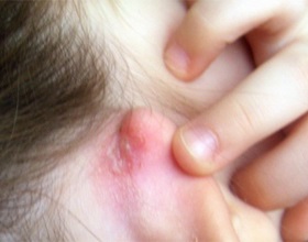 Vizesek mögött fülek csecsemők okoz és kezelés, ru-babyhealth
