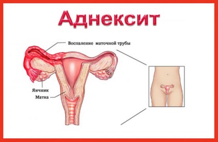 Fie că este posibil să rămâneți gravidă la o inflamație a adaosurilor (adnexită)