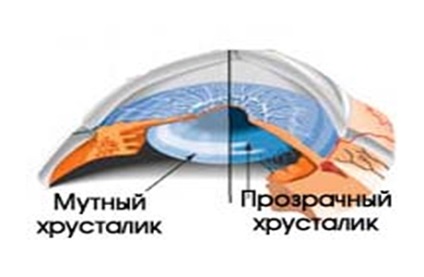 Cataracta inițială pentru cataractă în stadiul inițial