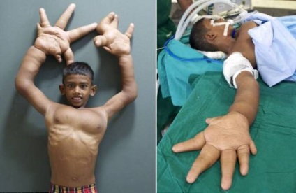 O mână imensă a fost redusă la un băiat din India