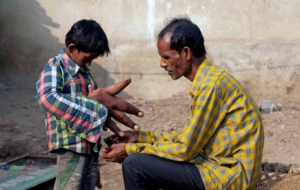 O mână imensă a fost redusă la un băiat din India