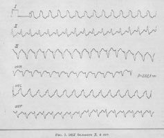 Caracteristicile înregistrării ecg în asistența medicală de urgență