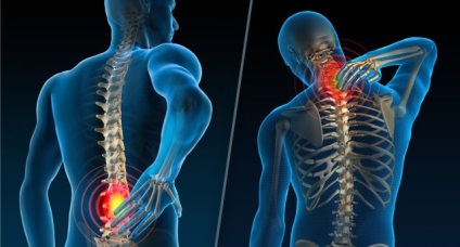 Osteochondrosis - cauze, simptome, tratamentul si prevenirea bolilor degenerative de disc de col uterin