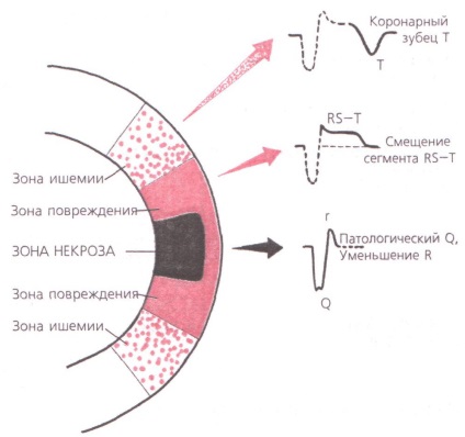 Infarct miocardic acut al peretelui anterior - tratamentul inimii