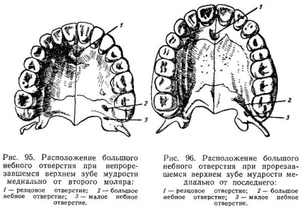 palatális érzéstelenítés