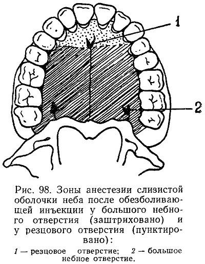 palatális érzéstelenítés