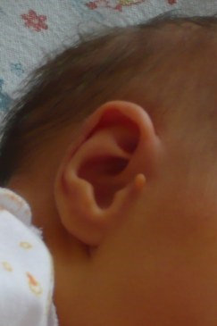 Papilloma la ureche cum să identifice și să elimine caracteristicile papiloamelor în urechile copiilor