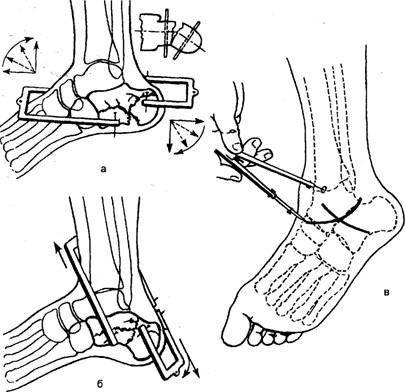 Fracturi de calcaneus - stadopedie