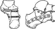 Fracturi de calcaneus - stadopedie