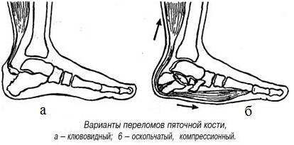 Fracturi de calcaneus - stadopedie