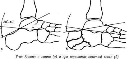 Fracturi de calcaneus - stadopedie