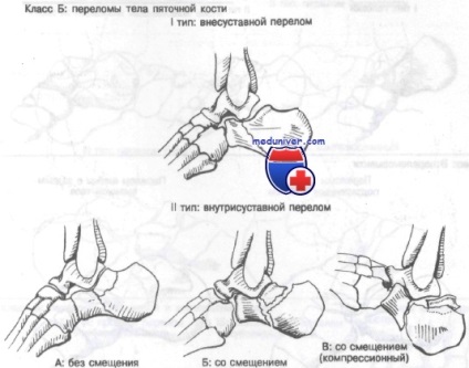 Fracturile corpului calcaneus