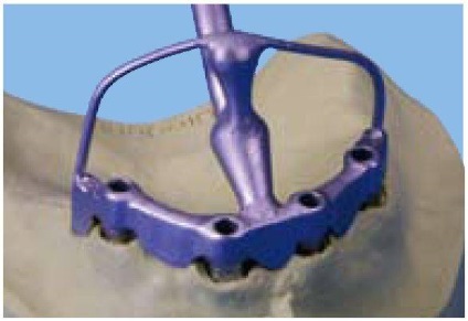 Elsődleges szerkezet protézis implantátumokra
