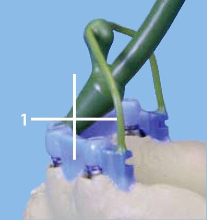 Structuri primare pentru proteze pe implanturi