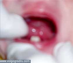 Az első fogászati ​​problémák gyermekeknél