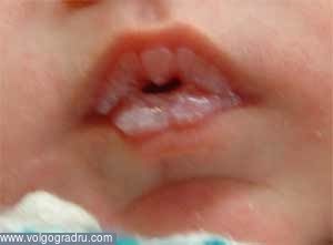 Primele probleme dentare la copii
