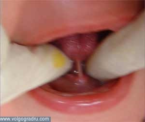 Primele probleme dentare la copii