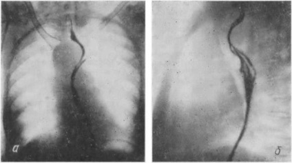 Segmente de esofag, tomografie computerizată