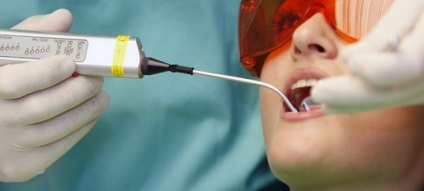 Előnye és hátránya a lézeres fogászati ​​kezelések