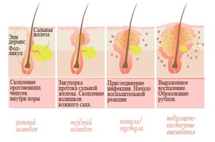 De ce și de la ceea ce apar acnee la adulți
