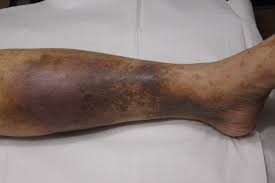 De ce are pigmentarea pielii pe picioare cu varice și cum să scapi de ea
