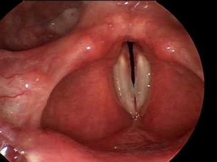 Lipsa de laringită (falsă crupă) simptome și de prim ajutor