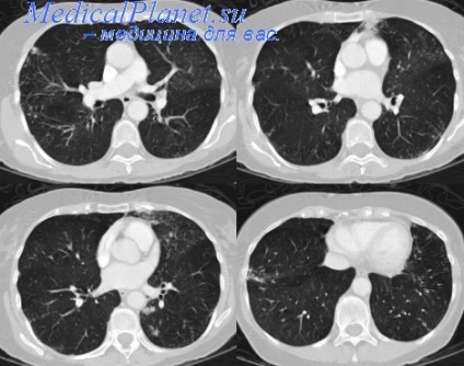Lateral tomografie transversală a plămânilor