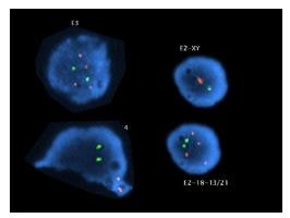 Diagnostic genetic preimplantare