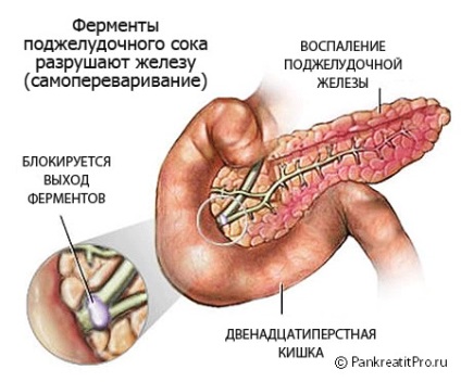 Cauzele de pancreatită