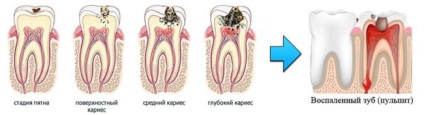 Tipurile de dinți pulpa, simptomele și tratamentele