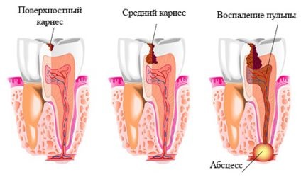 Tipurile de dinți pulpa, simptomele și tratamentele