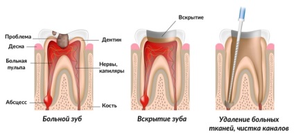 Tipurile de dinți pulpa, simptomele și tratamentele