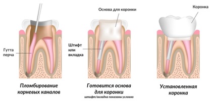 Tipurile de dinți pulpa, simptomele și tratamentele
