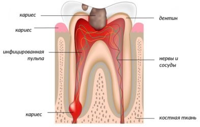 Tipurile de dinți pulpa, simptomele și tratamentele