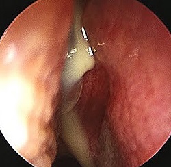 Rinita - cauze, simptome, diagnostic și tratament