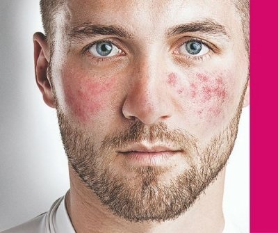 Rosacea - cauze, simptome și tratament, fotografie