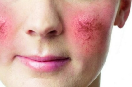 Rosacea - cauze, simptome și tratament, fotografie